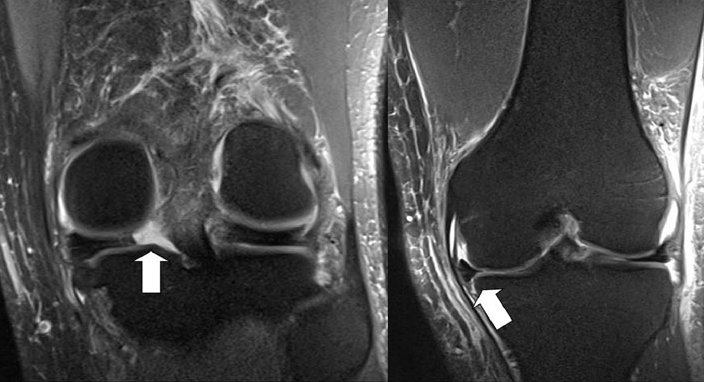 meniscus root tear with extrustion