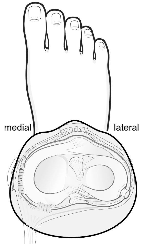 the lateral meniscus