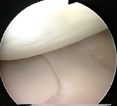 arthroscopic photograph of a knee meniscus