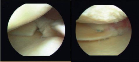 meniscus root tear before and after fixation