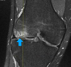 osteochondritis dissecans of femoral condyle