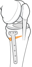 opening wedge high tibial osteotomy
