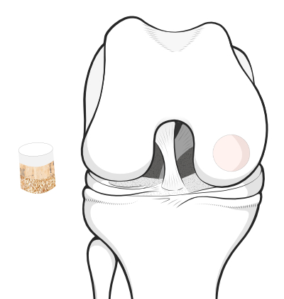 osteochondral graft plug ready to be pushed into the prepared recipient site