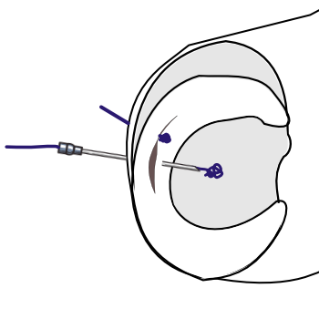 outside-in mulberry knot suture of meniscus