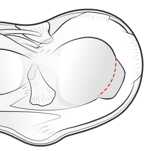 partial meniscectomy