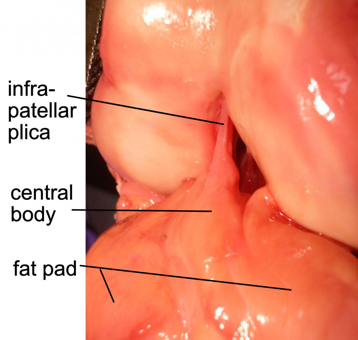 interior of knee showing infrapatellar plica