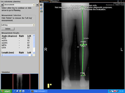 planning software for osteotomy