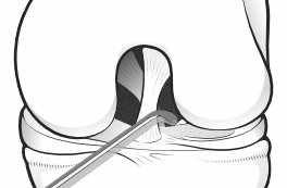 probing the meniscal root