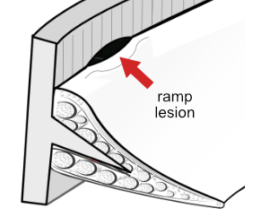 ramp lesion of menisco-capsular junction