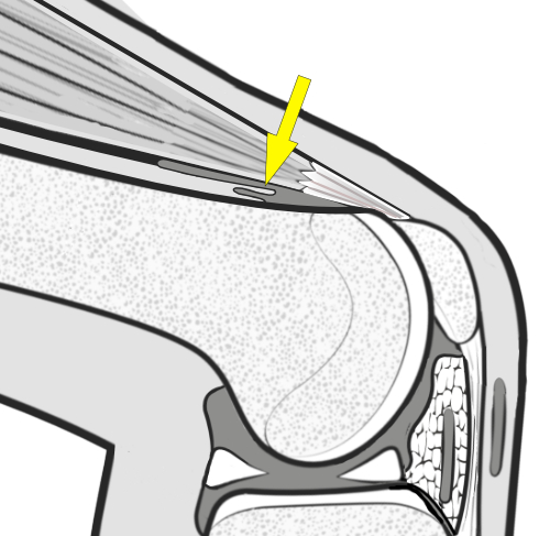 suprapatellar plica being nipped between quads and femur