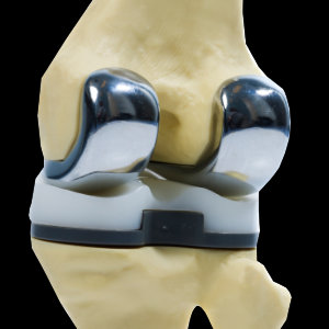 components of a total knee arthroplasty