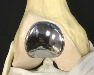 trochlear implant