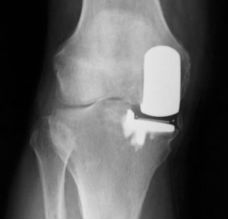 partial knee replacement on medial side