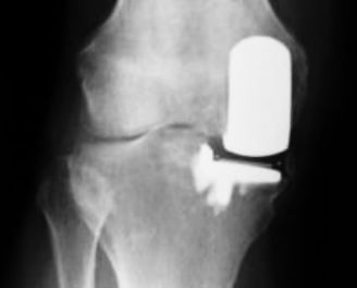 unicompartmental knee replacement