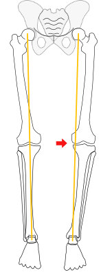 varus deformity in one knee