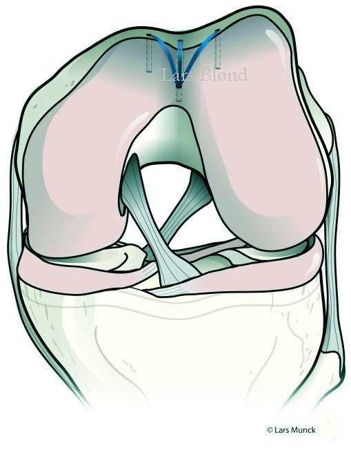arthroscopic trochleoplasty