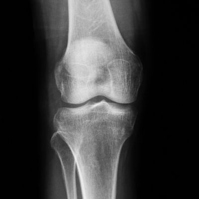 ap x-ray of knee
