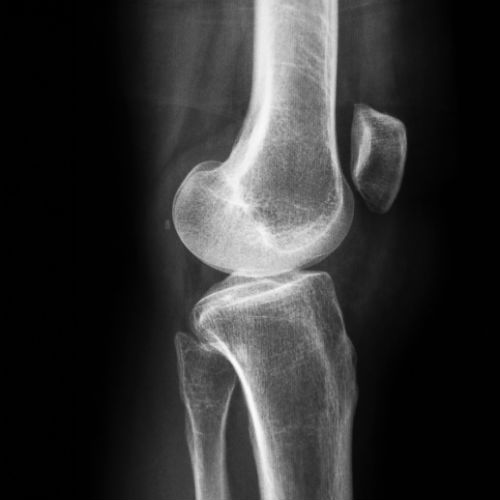 knee bones from the side