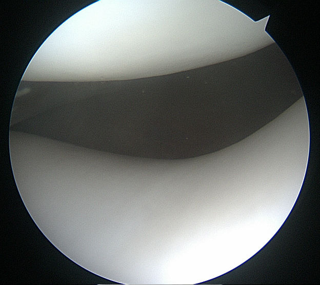 photo taken through the arthroscpe