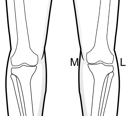 medial joint space narrowing on both sides