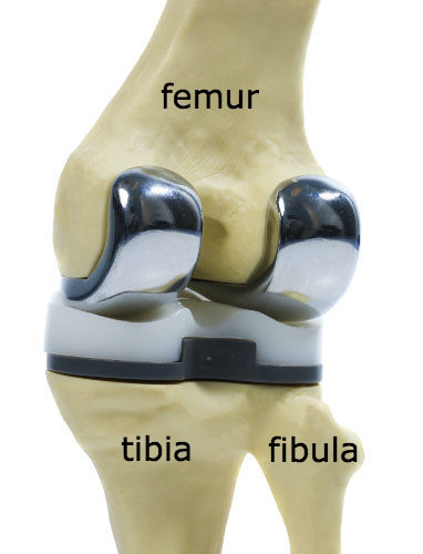 total knee replacement on model