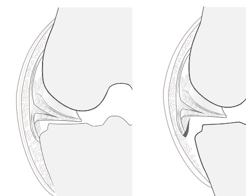 menisco-tibial avulsion or floating meniscus