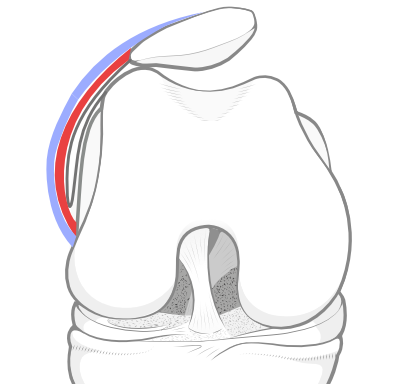patellar tilt due to a tight lateral retinaculum